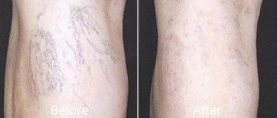 Laser Vein Removal Before & After Photos in Syracuse, New York at CNY Cosmetic & Reconstructive Surgery