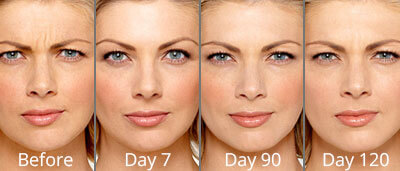 Botox Before & After Photos in Syracuse, New York at CNY Cosmetic & Reconstructive Surgery