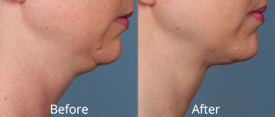 Kybella Before & After Photos in Syracuse, New York at CNY Cosmetic & Reconstructive Surgery