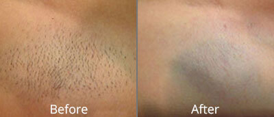 Laser Hair Removal & Waxing Before & After Photos in Syracuse, New York at CNY Cosmetic & Reconstructive Surgery